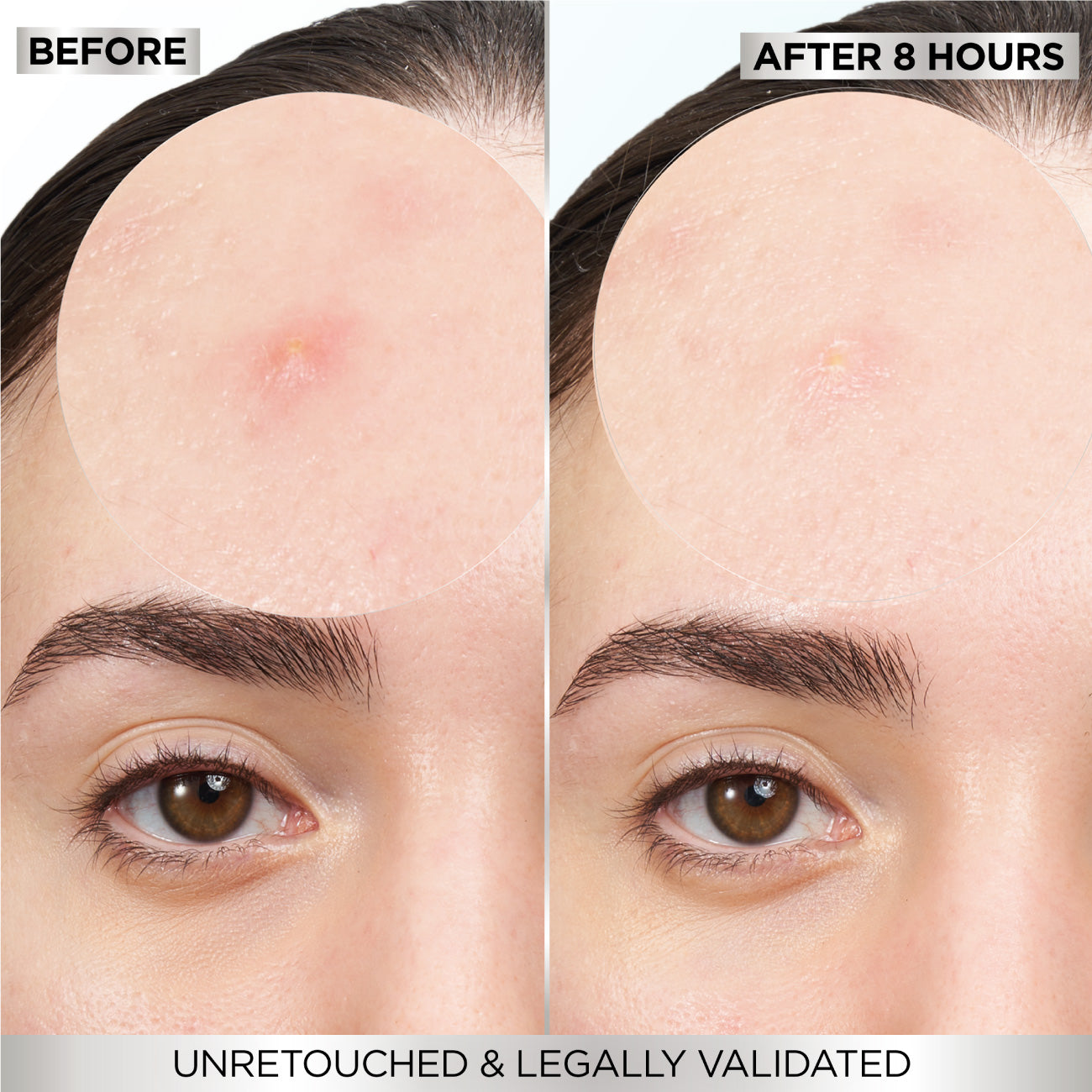 Garnier Skin Active  Fast Clear Invisible Pimple Patch 8 Hours Hydrocolloid 22patches