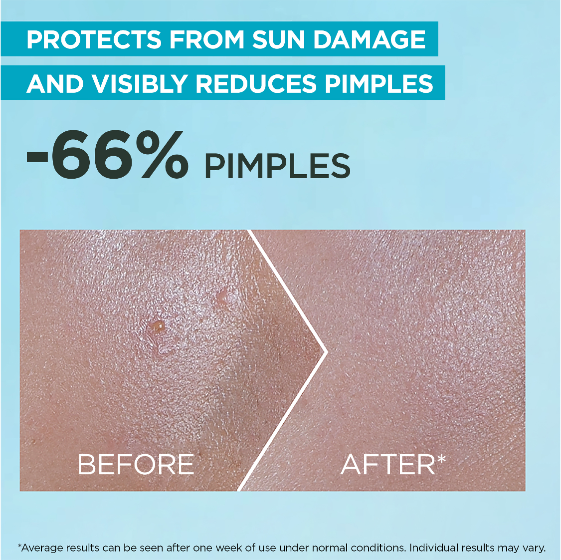 GARNIER Skin Active Super UV Anti Acne  SPF50+ 30ml